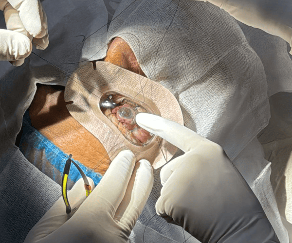 Alta precisión en Radiocirugía Ocular
